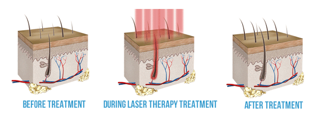 Laser Hair Restoration Technique